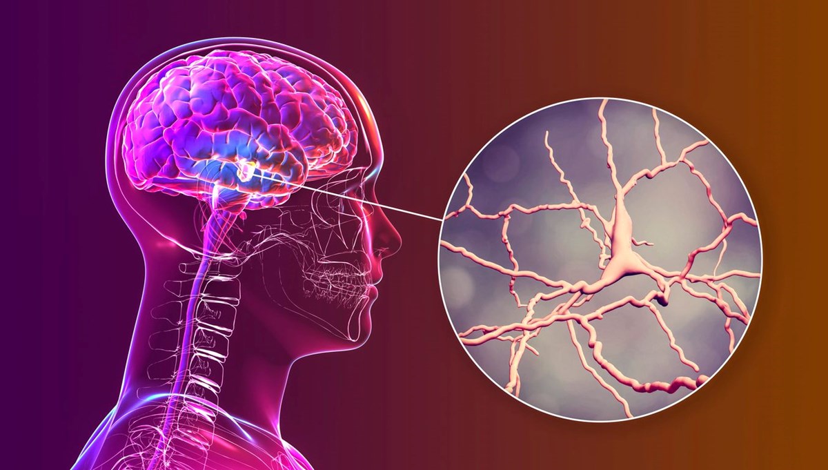 Parkinson tedavisinde önemli gelişme: Kök hücre tedavisi başarılı sonuç verdi